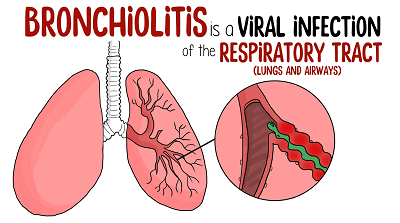 bronkiolitis